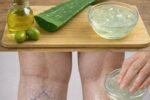 Grandma’s Remedy for Varicose Veins: Natural Recipe with Aloe Vera, Apple Cider Vinegar, and Lemon