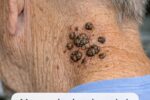 My grandpa has these dark waxy bumps on his neck that itch. What are they?