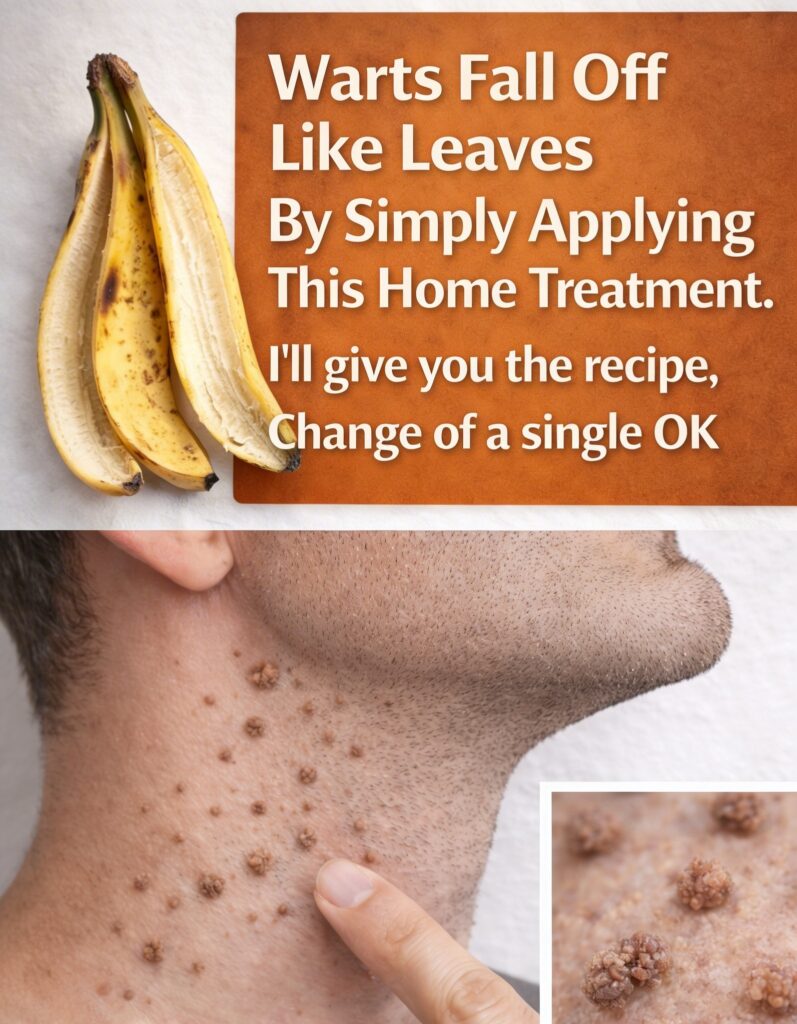 Do Banana Peels Really Help Remove Warts? A Simple Home Remedy Explained