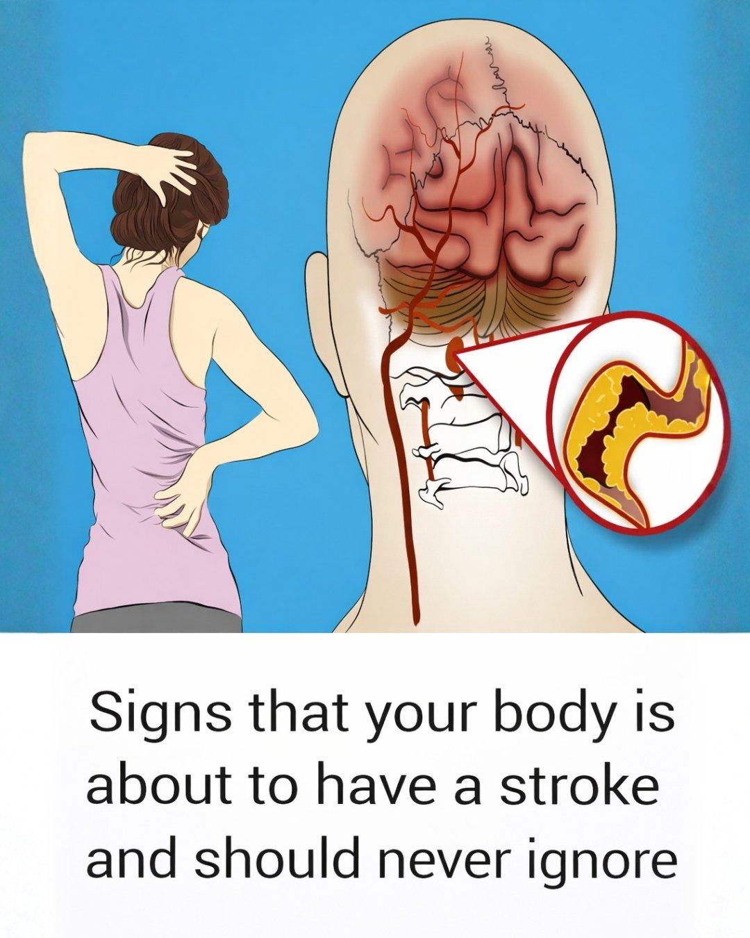 10 Early Warning Signs Your Body Might Be Signaling a Stroke (Don’t Ignore These)