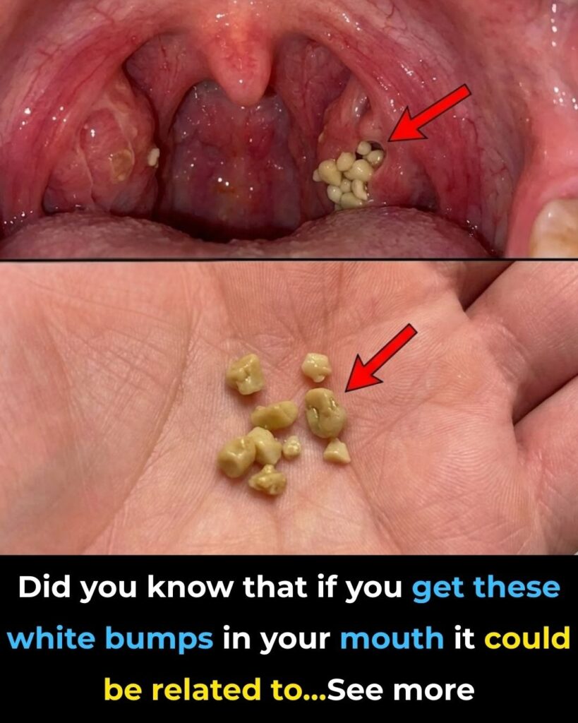 Causes of White or Yellow Balls on the Tonsils – What They Are & How to Treat Them
