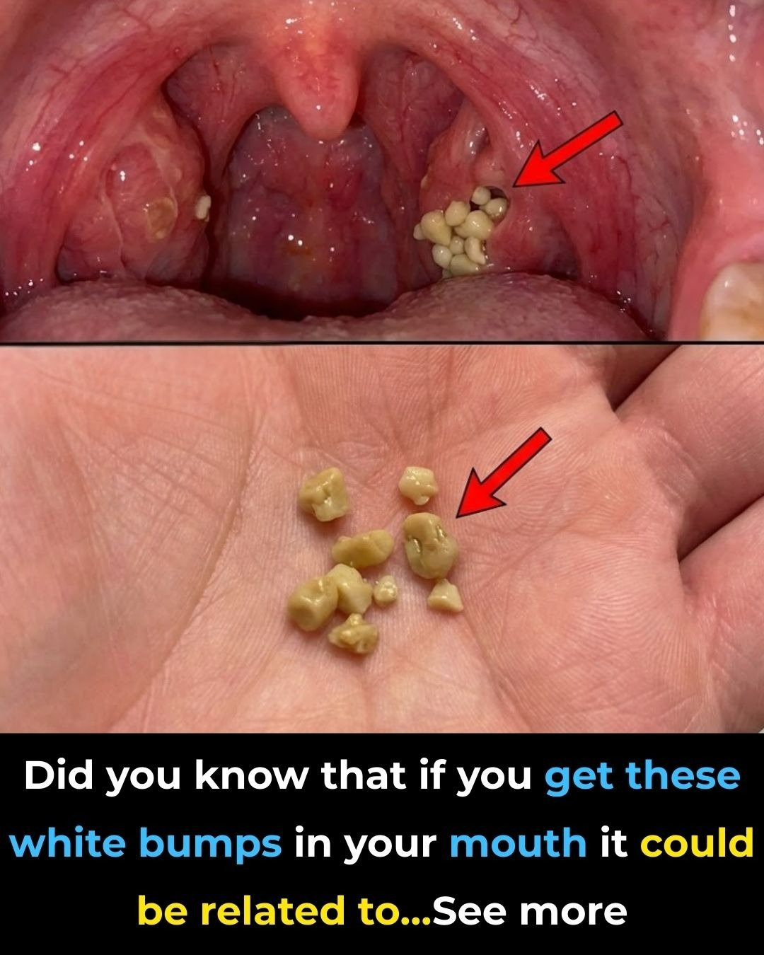 Causes of White or Yellow Balls on the Tonsils – What They Are & How to Treat Them