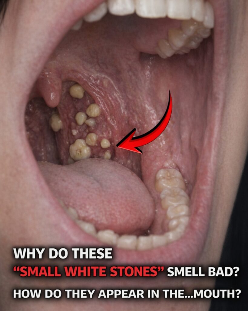 😮💨 What Are Those Smelly White “Stones” in Your Mouth That Cause Terrible Bad Breath?