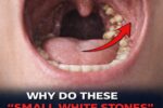 Those small, smelly white stones that sometimes appear (or get coughed up) in your mouth are most commonly known as tonsil stones, or medically as tonsilloliths.