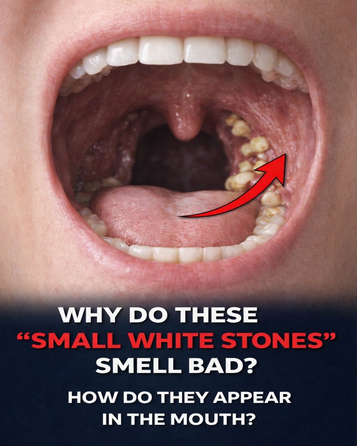Those small, smelly white stones that sometimes appear (or get coughed up) in your mouth are most commonly known as tonsil stones, or medically as tonsilloliths.