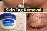 How to Explore Natural Home Approaches for Skin Tags Using Vaseline and Common Ingredients