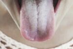 Understanding the Causes of a White Tongue: What Your Tongue May Be Telling You