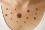 Brown Spots Suddenly Appearing on Your Chest? Here’s What They Might Mean