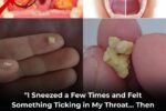 How to get rid of tonsil stones in a natural and simple way