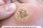 Painful Hard Spot With Black Dots on the Sole? It Could Be a Plantar Wart (Fast Relief Tips)