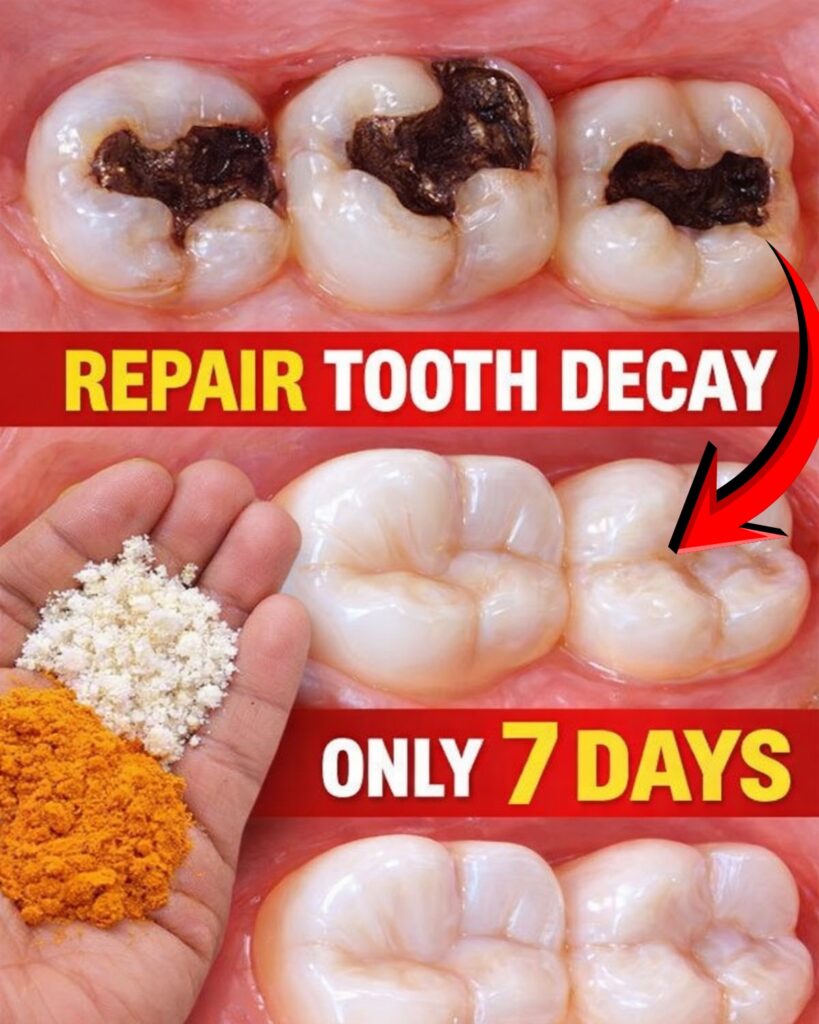 100% Natural Home Remedy for Tooth Decay, Yellow Teeth, and Tooth Pain