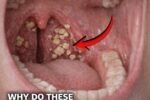 Those small, smelly white stones that sometimes appear (or get coughed up) in your mouth are most commonly known as tonsil stones, or medically as tonsilloliths.