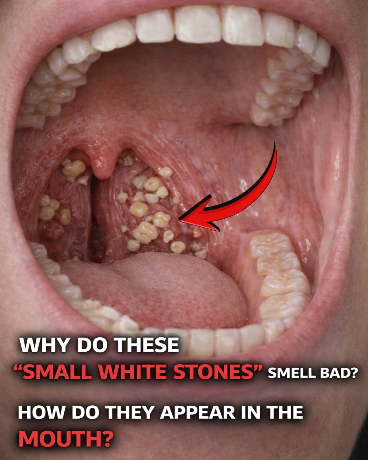 Those small, smelly white stones that sometimes appear (or get coughed up) in your mouth are most commonly known as tonsil stones, or medically as tonsilloliths.