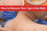 How to Remove Skin Tags in One Night Naturally at Home (Yes, Even With Something as Simple as Vaseline)