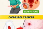 8 Signs of Ovarian Cancer Every Woman Should Watch For – Knowledge That Could Make a Difference