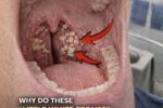 Tonsil Stones Revealed: The Hidden Cause Behind Bad Breath and Throat Discomfort