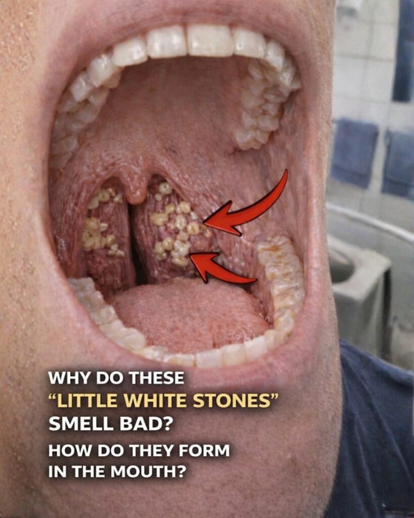 Tonsil Stones Revealed: The Hidden Cause Behind Bad Breath and Throat Discomfort