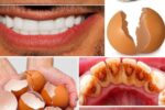 The “Secret” Dentists Don’t Tell You: A Natural Way People Use to Remove Tartar and Whiten Teeth