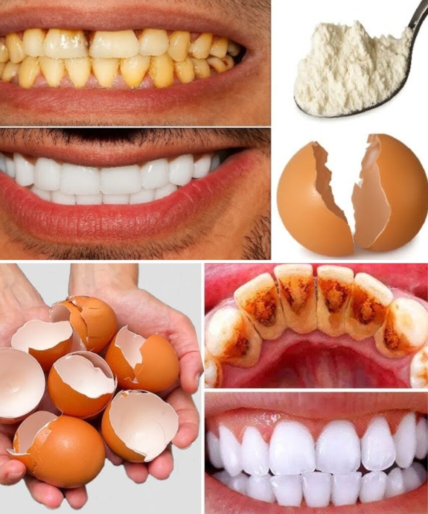 The “Secret” Dentists Don’t Tell You: A Natural Way People Use to Remove Tartar and Whiten Teeth