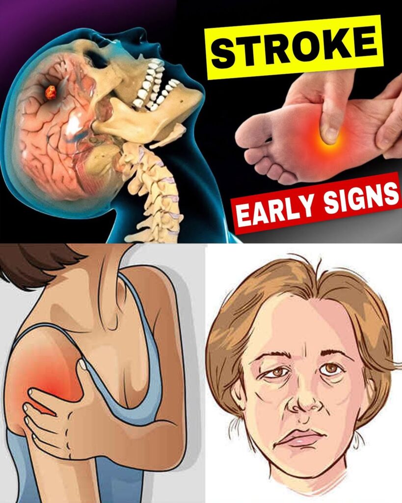 8 Warning Signs of Stroke That Can Appear Up to a Month Before + 9 Powerful, Evidence-Based Tips to Slash Your Risk