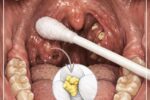 Tonsil Stones: A Hidden Cause of Persistent Bad Breath