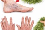 The Miracle of Rosemary for Varicose Veins: Noticeable Results in Just 1 Week?
