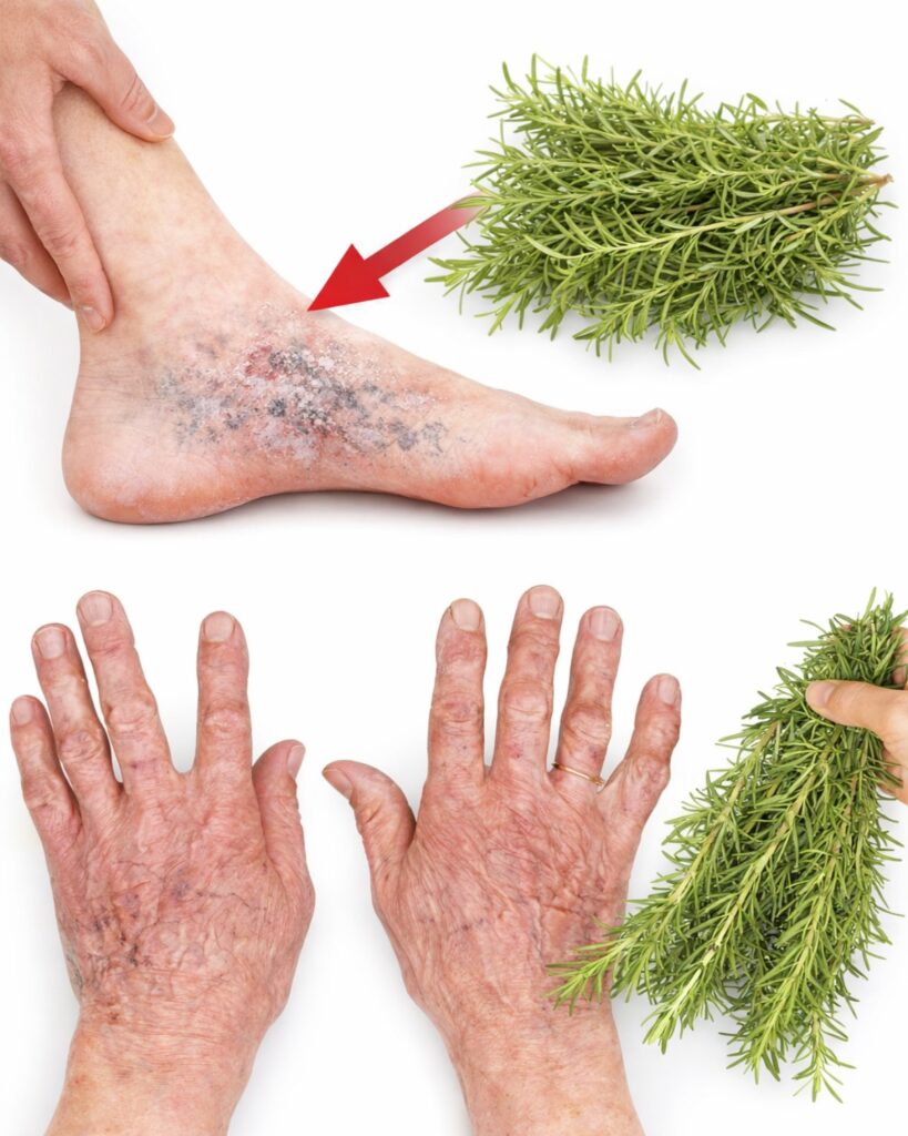 The Miracle of Rosemary for Varicose Veins: Noticeable Results in Just 1 Week?