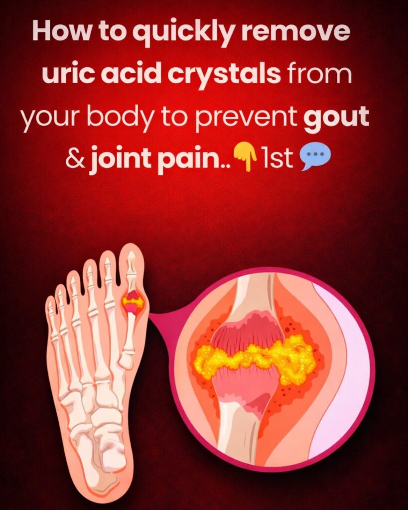 How to quickly remove uric acid crystals from your body to prevent gout and joint pain