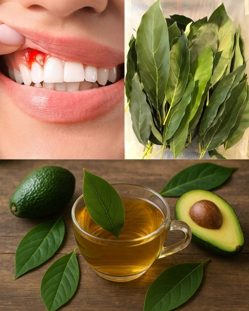Avocado Leaves Remedy for Gum Problems: Natural Relief for Swollen and Bleeding Gums