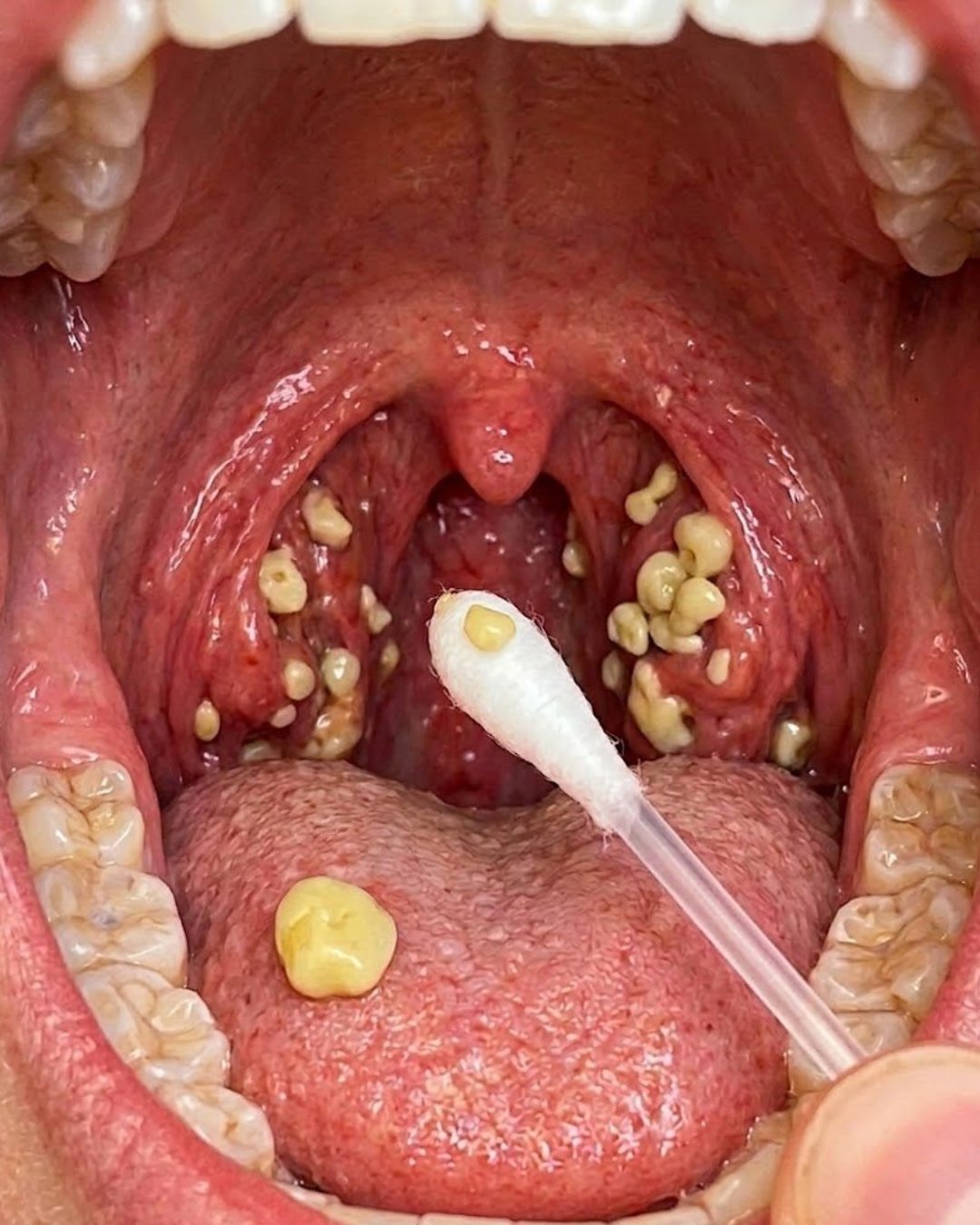 Bad Breath That Won’t Go Away? Could Tonsil Stones Be the Hidden Cause