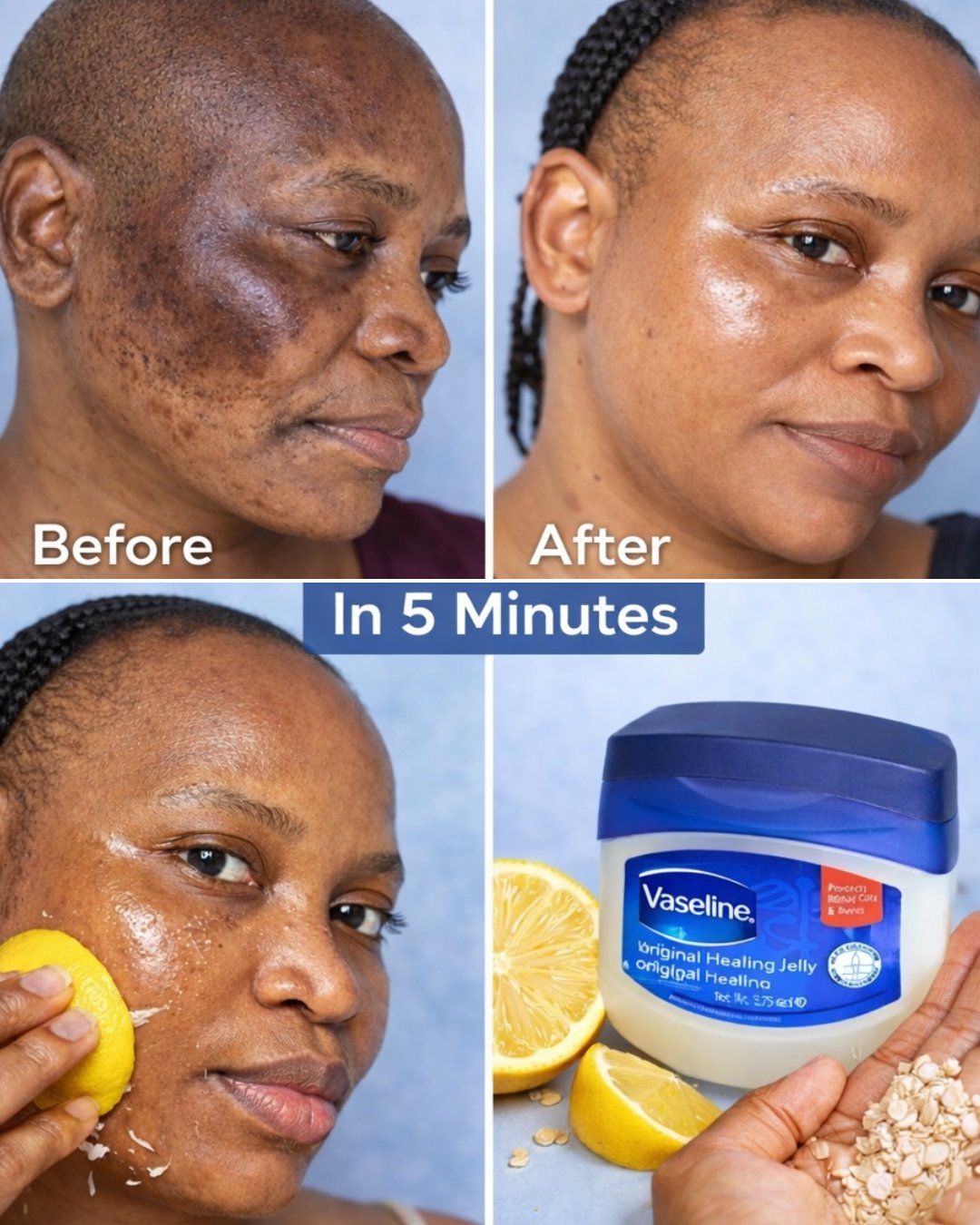 Can Lemon Juice Fade Acne Marks? Try This Natural Remedy